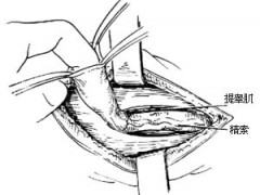 治疗小儿疝气注意事项