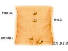 治疗疝气最新方法