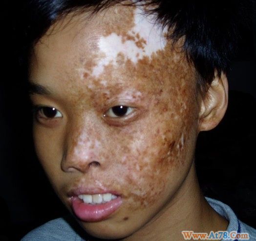 看世界杯导致喝咖啡导致烂脸导致失业，有脸上图求助！