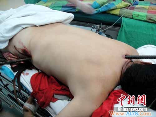 四川一男子被钢筋贯通躯干侥幸“逃生”(组图)