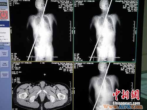 四川一男子被钢筋贯通躯干侥幸“逃生”(组图)